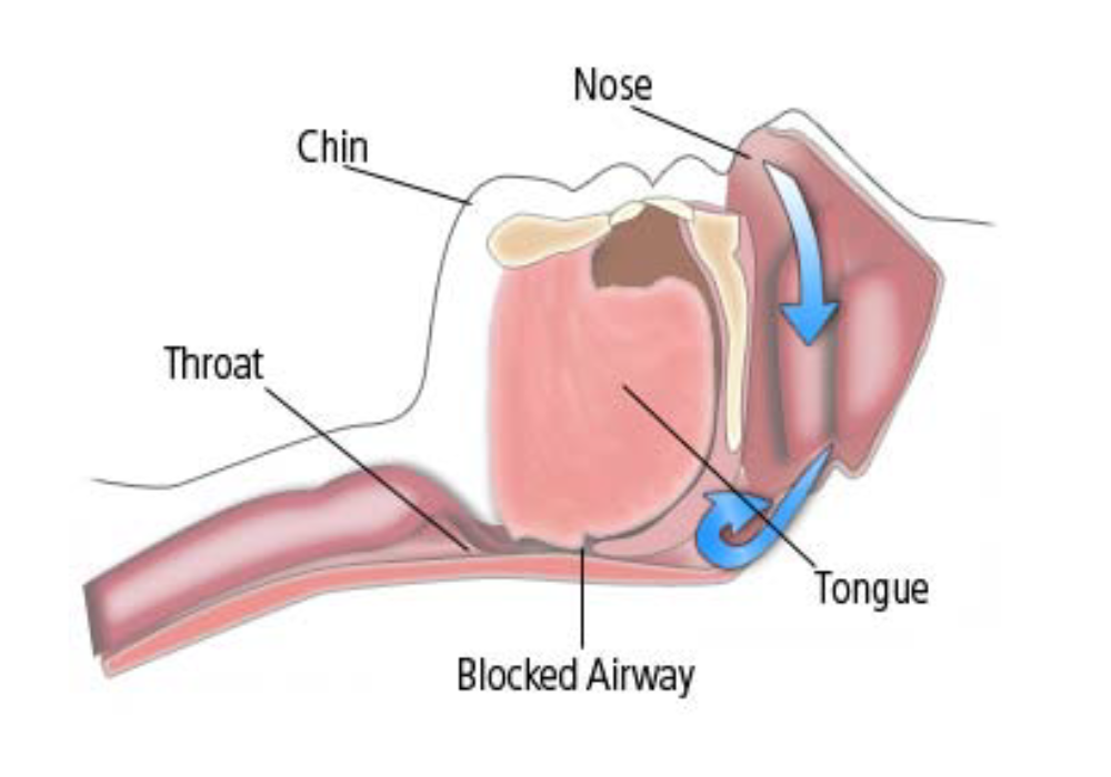 Facial Bone Fractures (6)