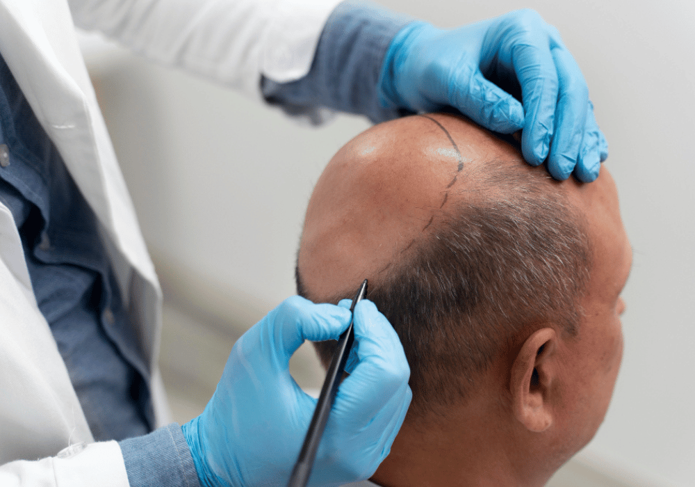 Hair Transplant (1)