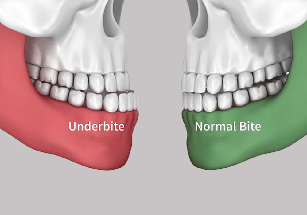 Underbite (1)